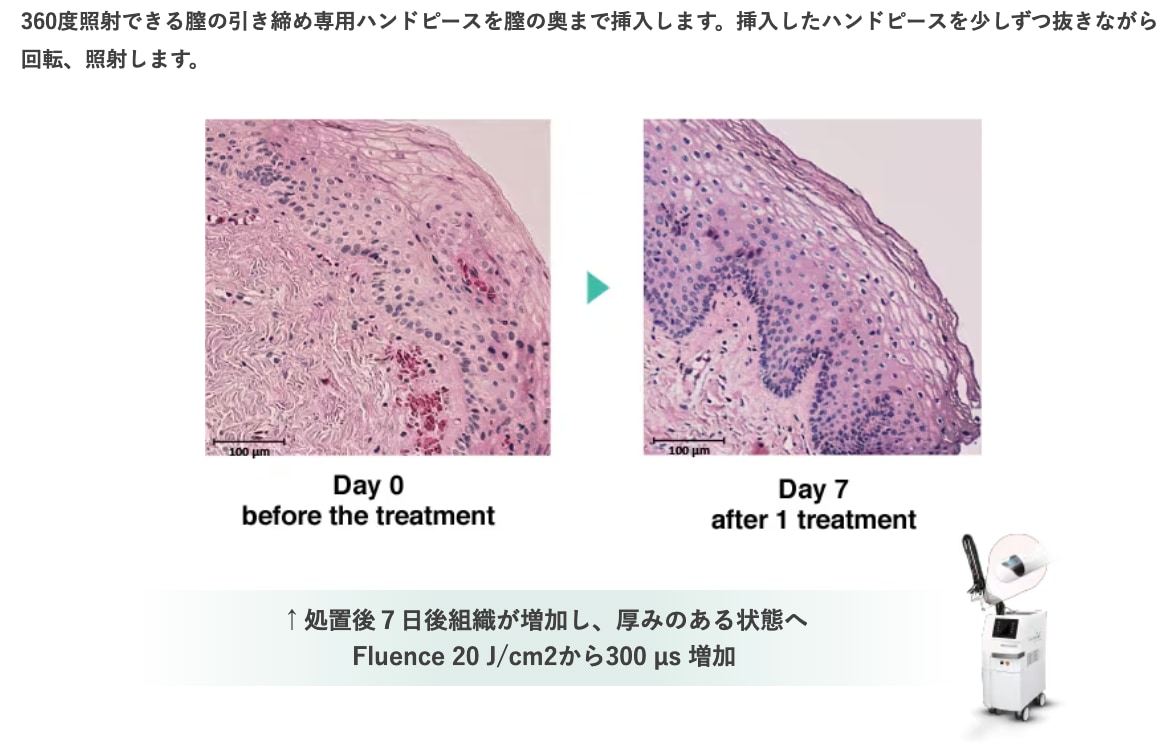 膣縮小ジュリエットレーザー