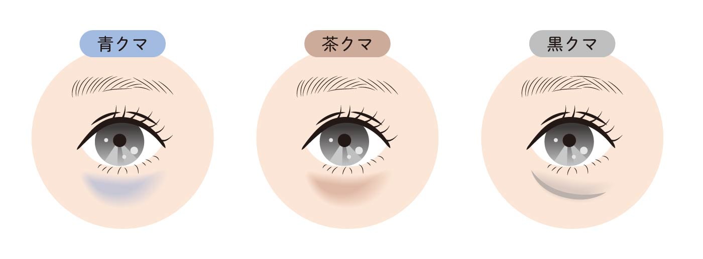 🔍あなたのクマはどのタイプ？