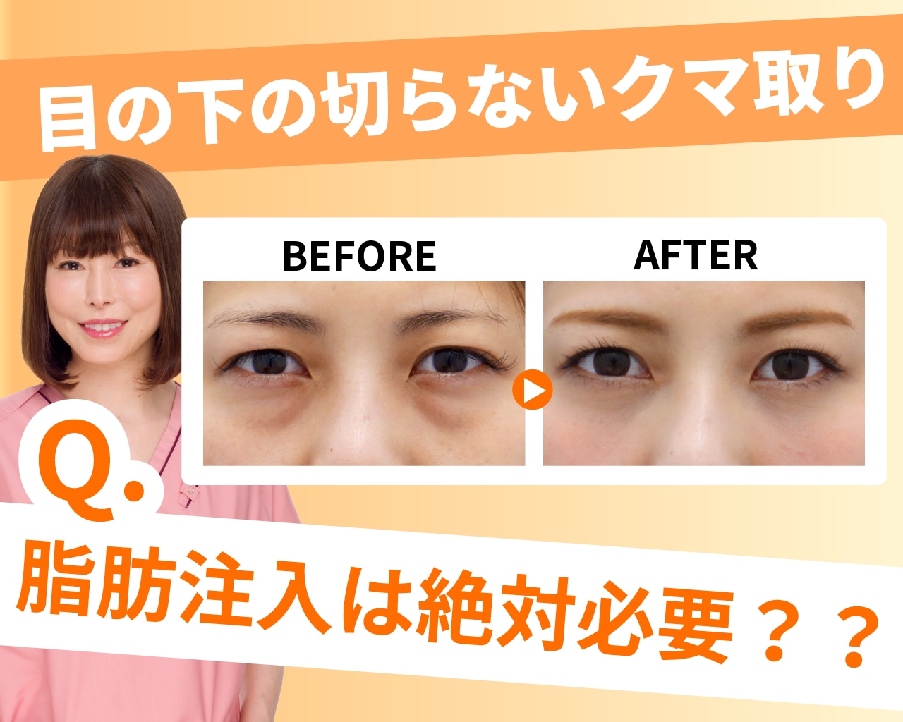 目の下のクマ取り「脂肪注入」は絶対必要？【湘南美容クリニック 銀座一丁目院】の岩砂院長が徹底解説！