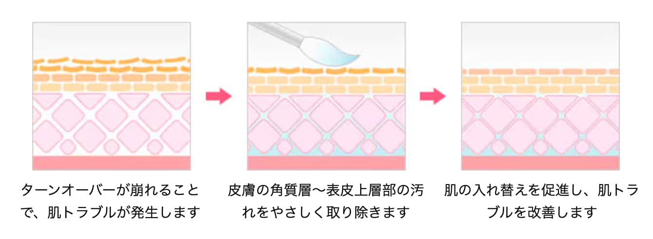 1. ケミカルピーリングでターンオーバーを正常化🫧