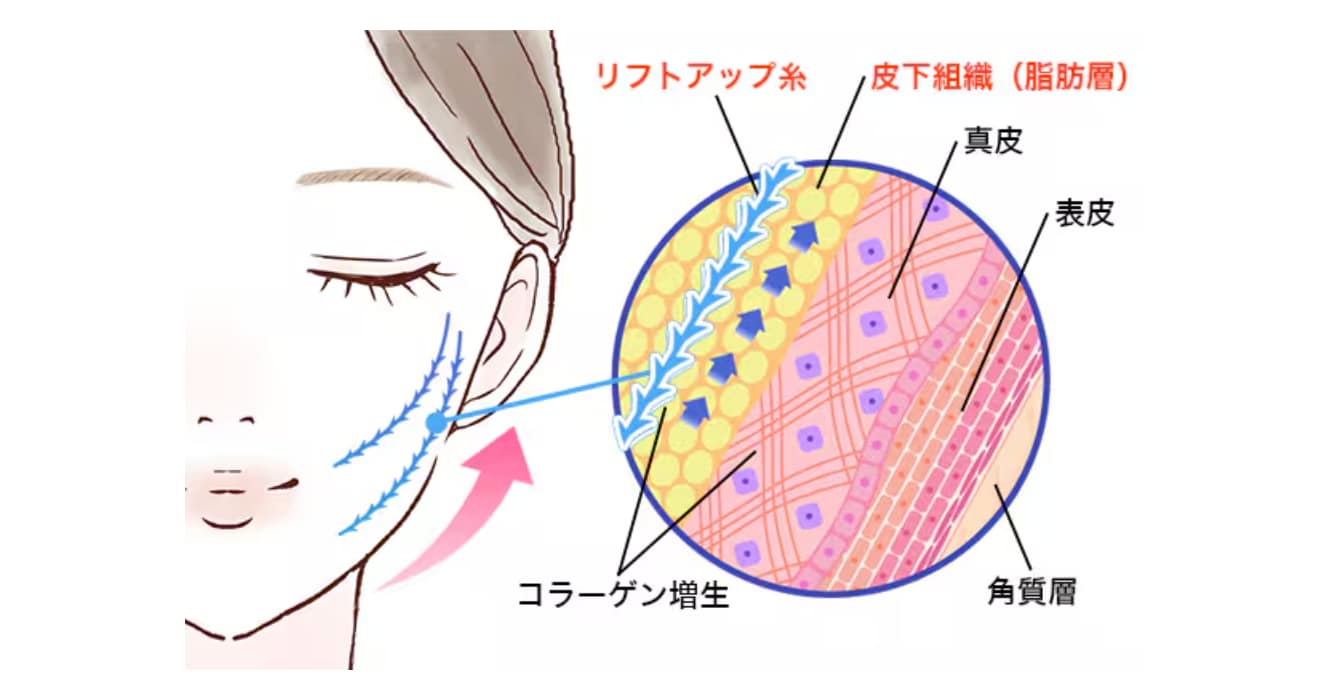 たるみの原因『下垂脂肪』を持ち上げる