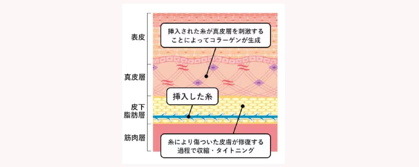 未来のたるみを予防