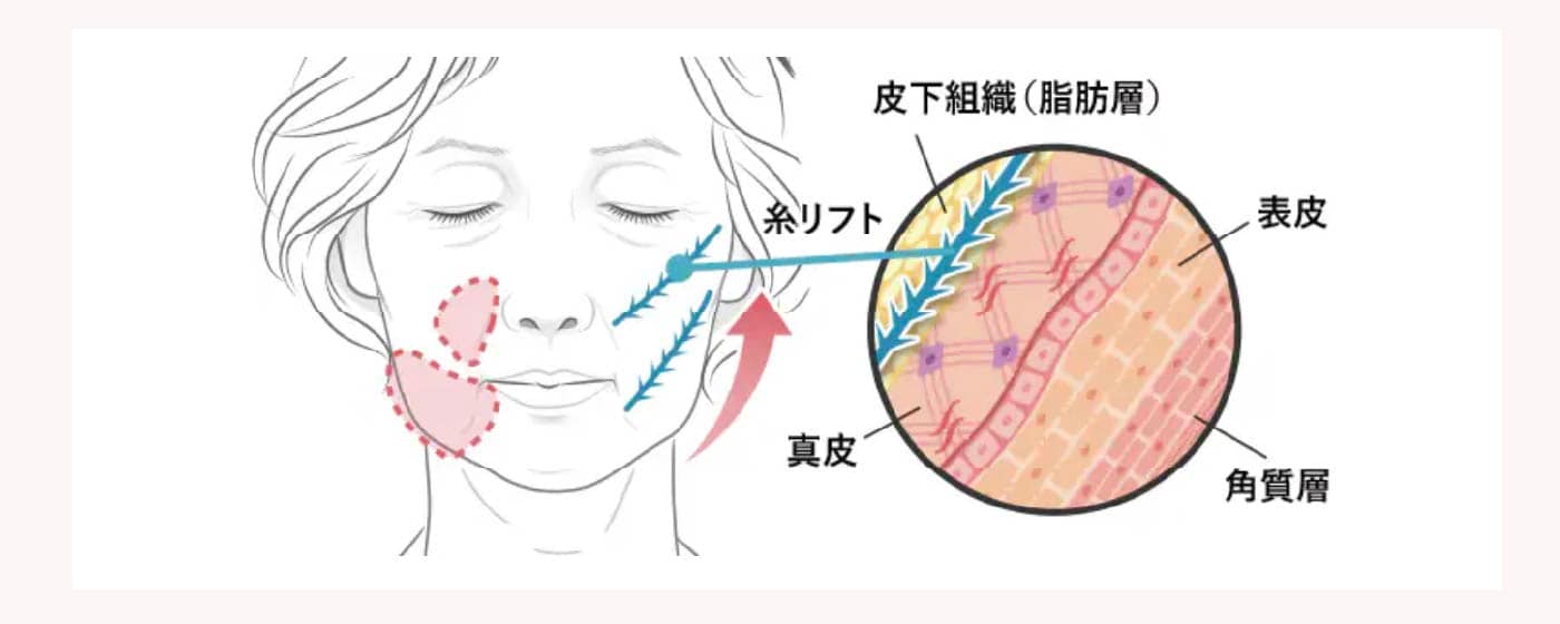 たるみ・もたつきを改善