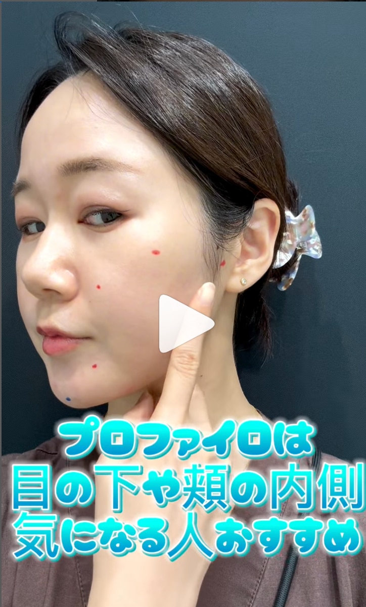 目から下の注入なら【プロファイロ】