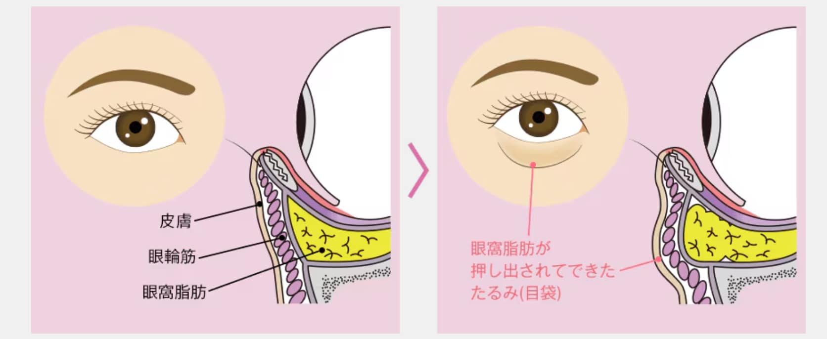 「眼窩脂肪（がんかしぼう）」をまぶたの裏側から取り除く