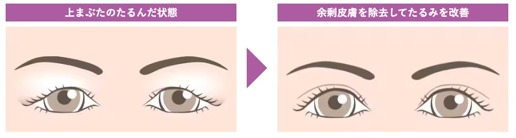二瓶多惠子医師の【眉下リフト】目元のたるみを根本から改善！