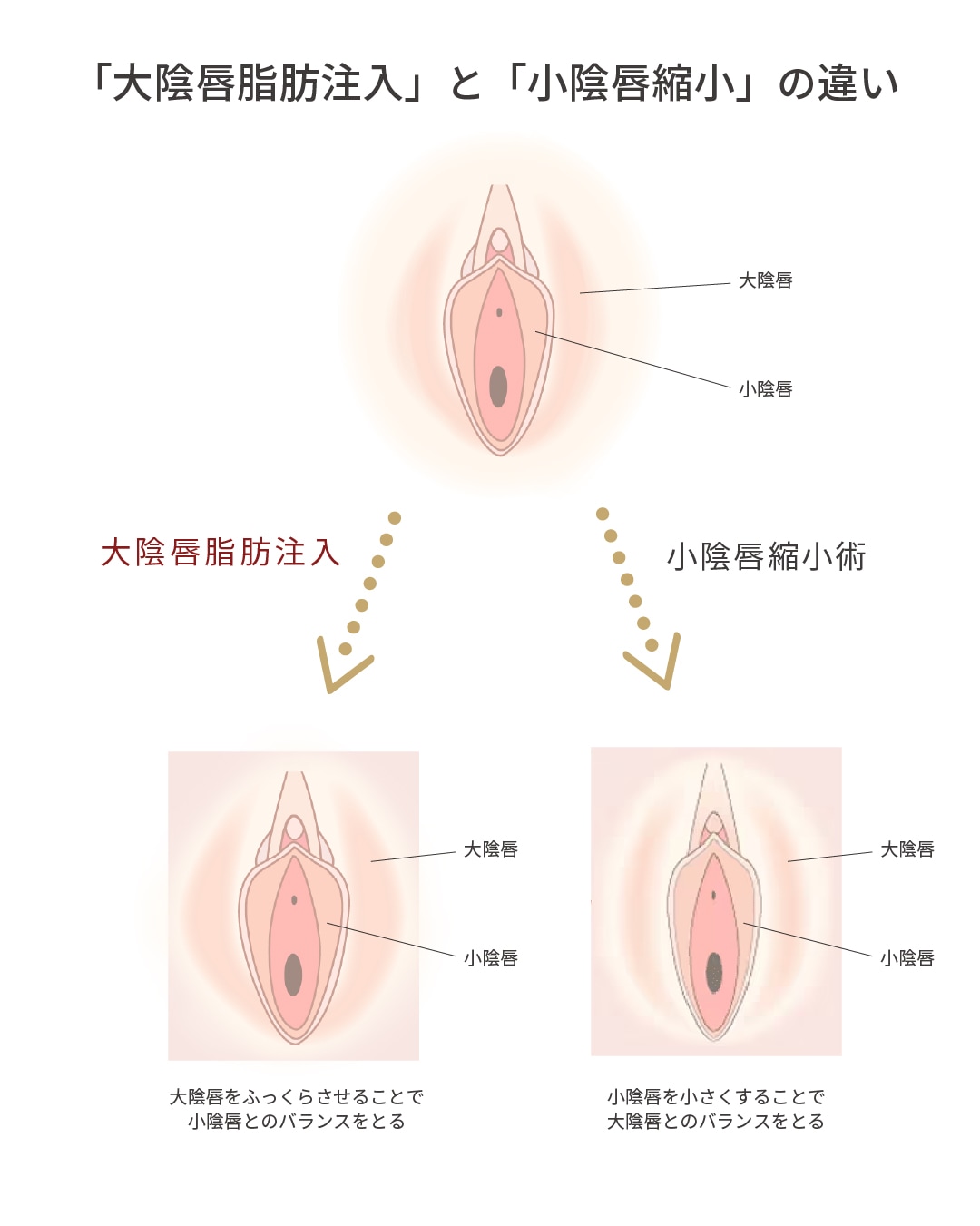 「足す」大陰唇脂肪注入と「引く」小陰唇縮小。<br />
共通するゴールは『黄金バランス』の改善