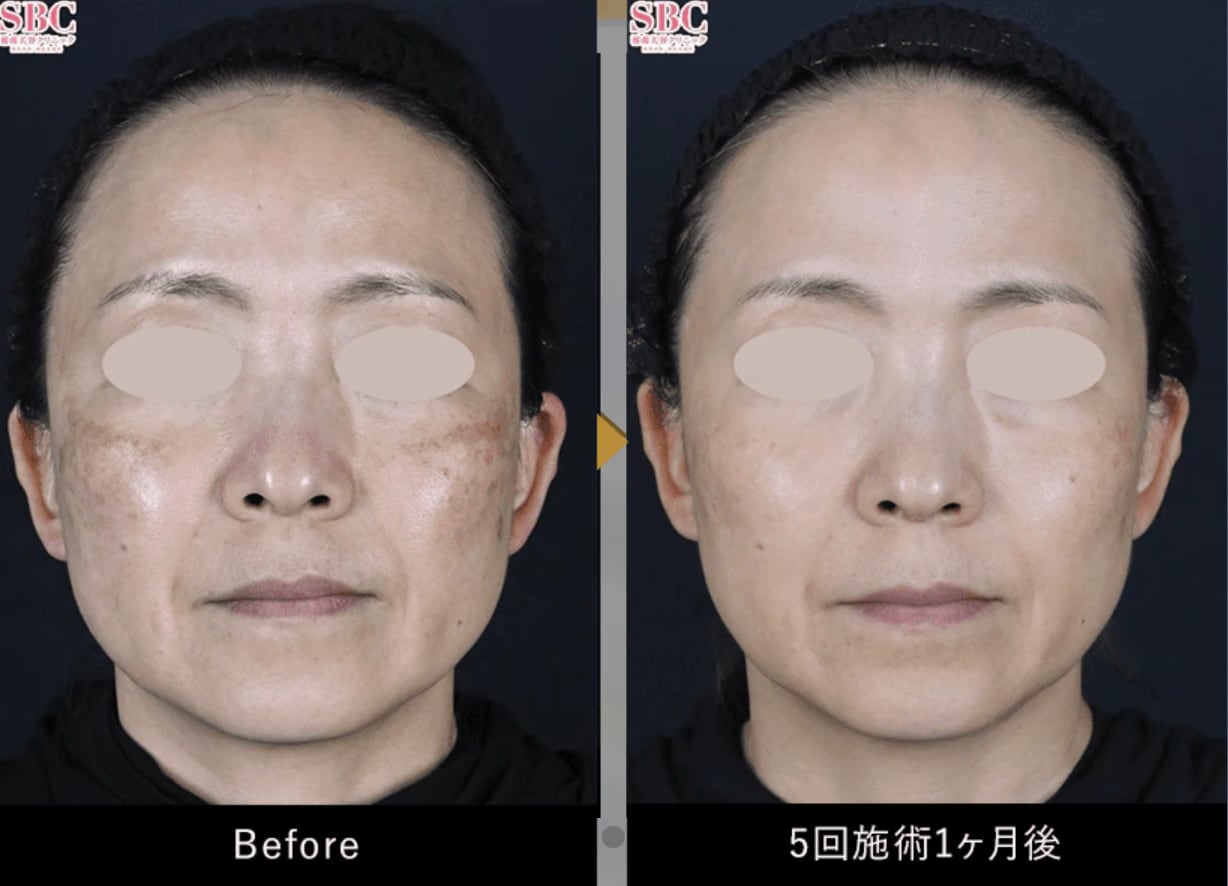 「肝斑」も「毛穴」も「赤み」も一度にケア！