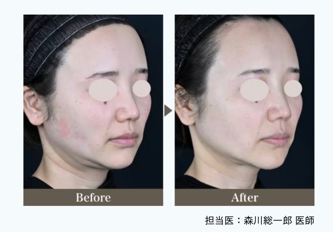 メスを使わず、肌を強力に引き締める「王道」施術