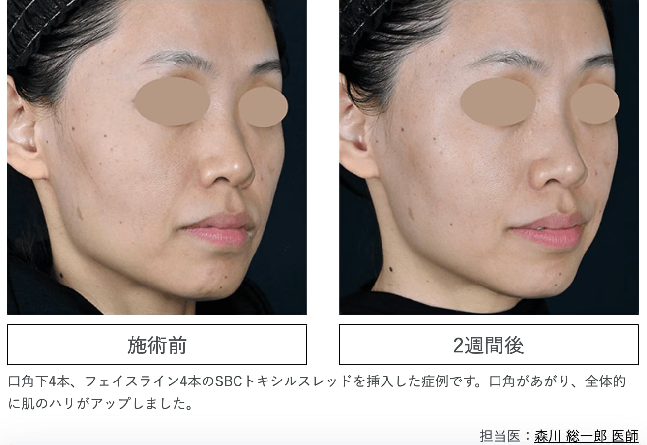 「糸」×「ボトックス」で、ピンと張った透明感