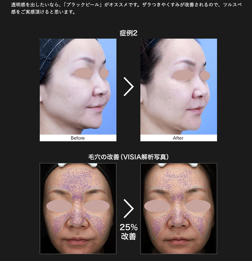 毛穴汚れをごっそり吸着＆美白ケア