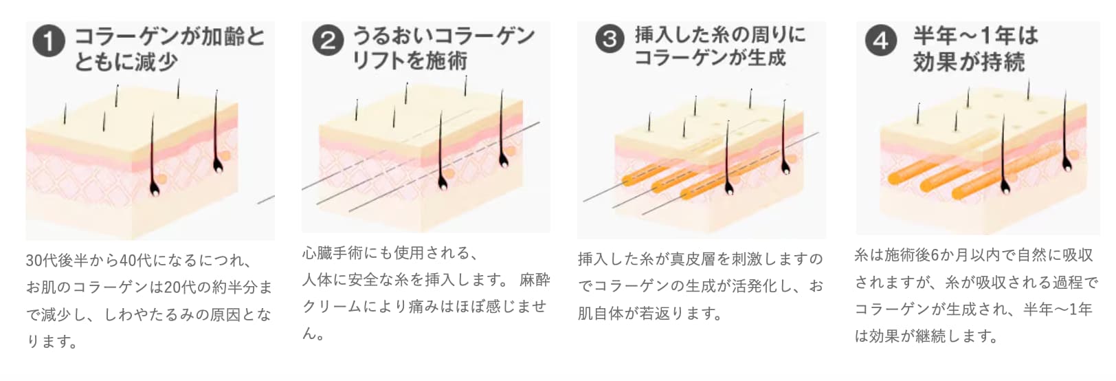 うるおいコラーゲンリフトとは？