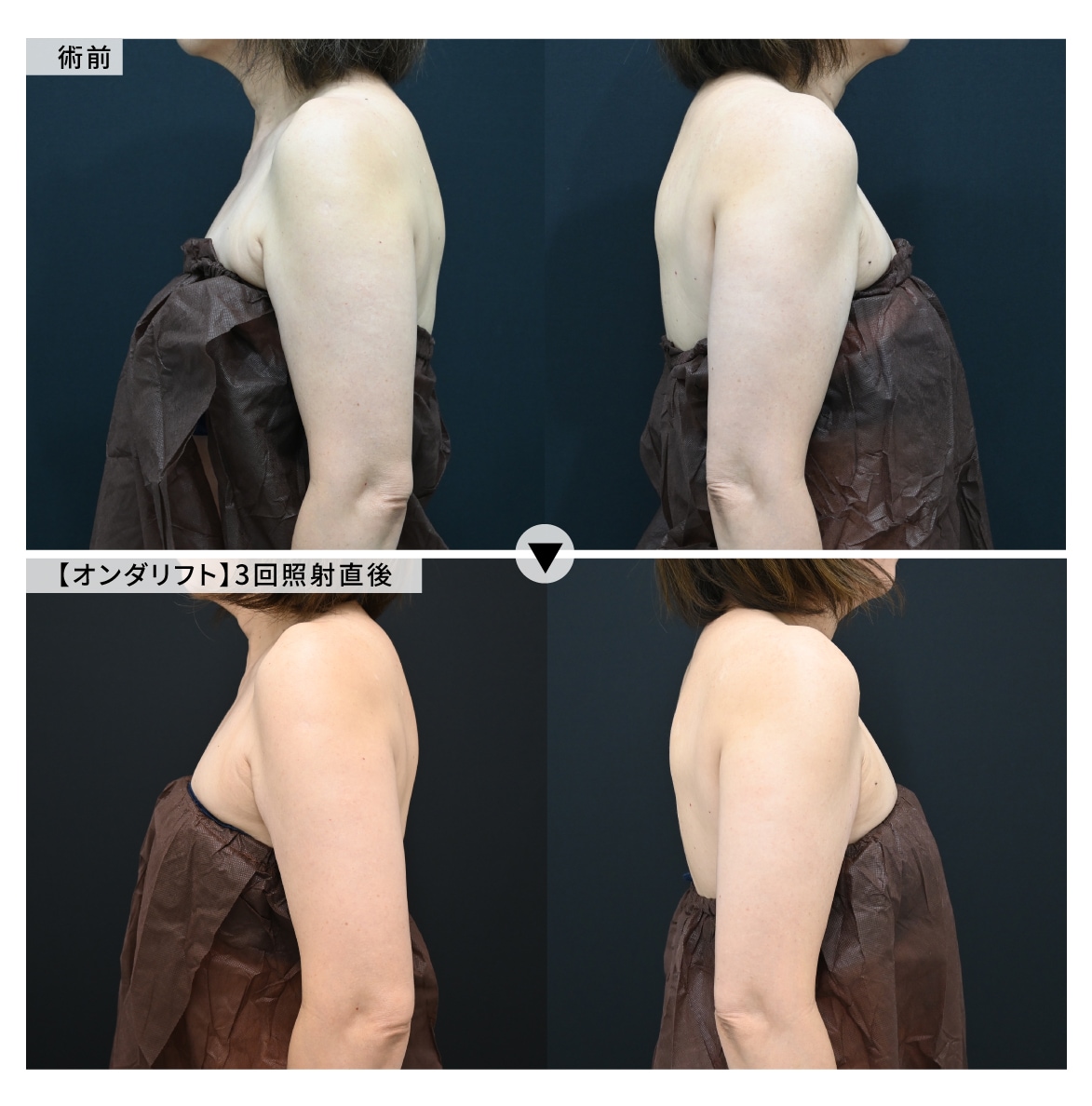 【ボディ】二の腕