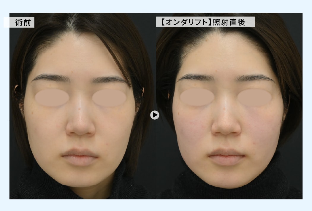 ダウンタイムは直後に「赤み」が出る程度