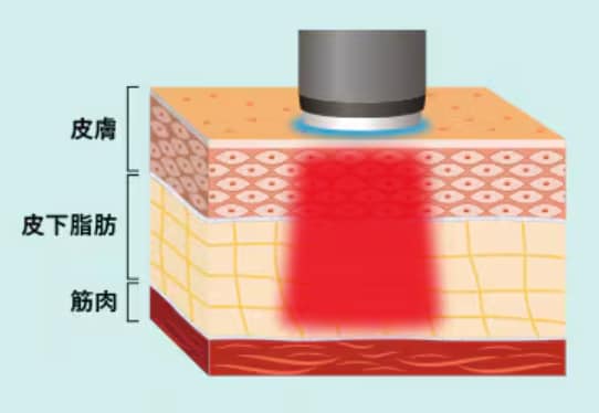 冷却装置付きで痛みを軽減！