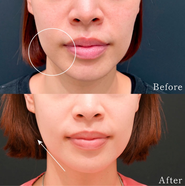 初期のたるみ・ほうれい線解消