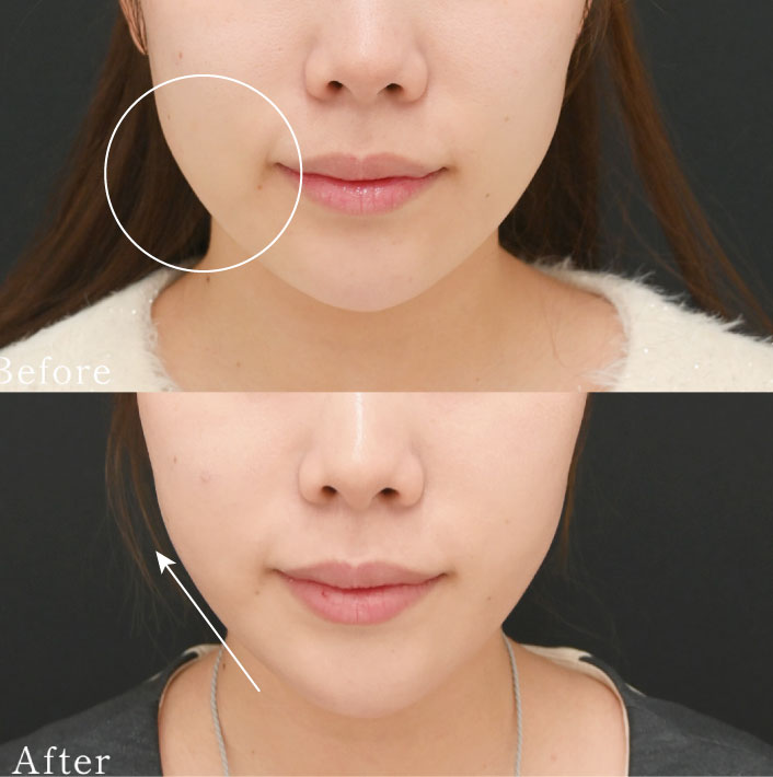 小顔・タイトニング・予防