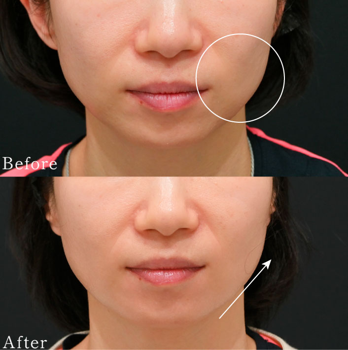 本格的なリフトアップ・若返り<br />
