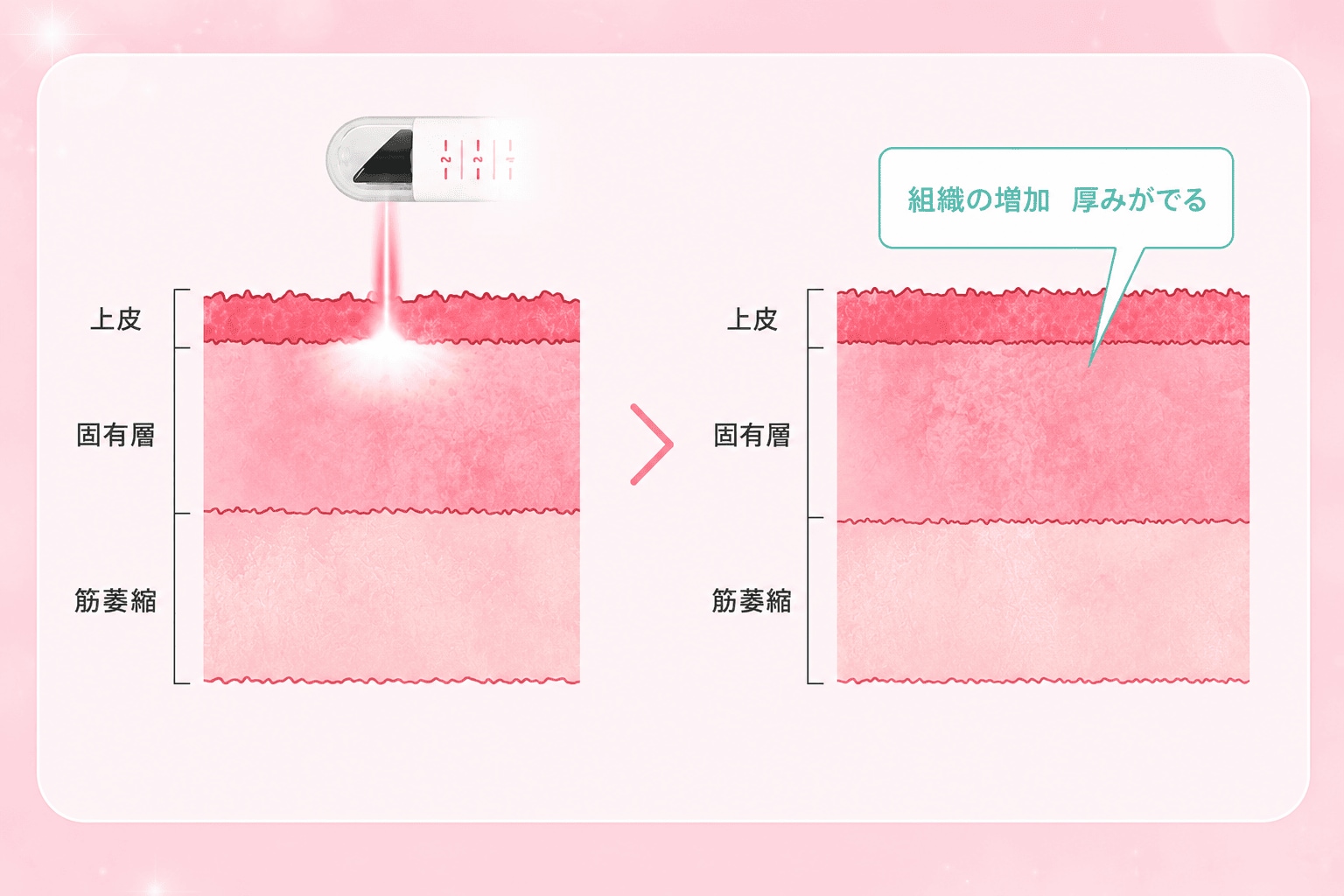 そんなお悩みにお応えするレーザー治療です。