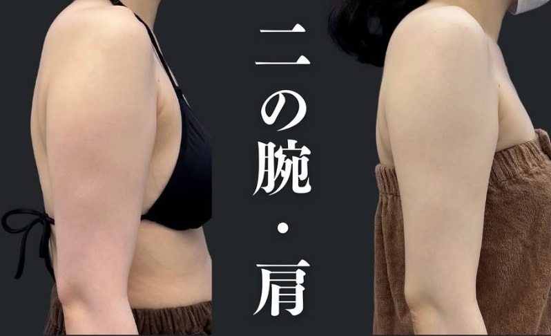 二の腕・肩