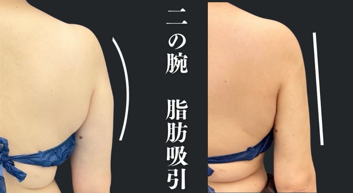 二の腕