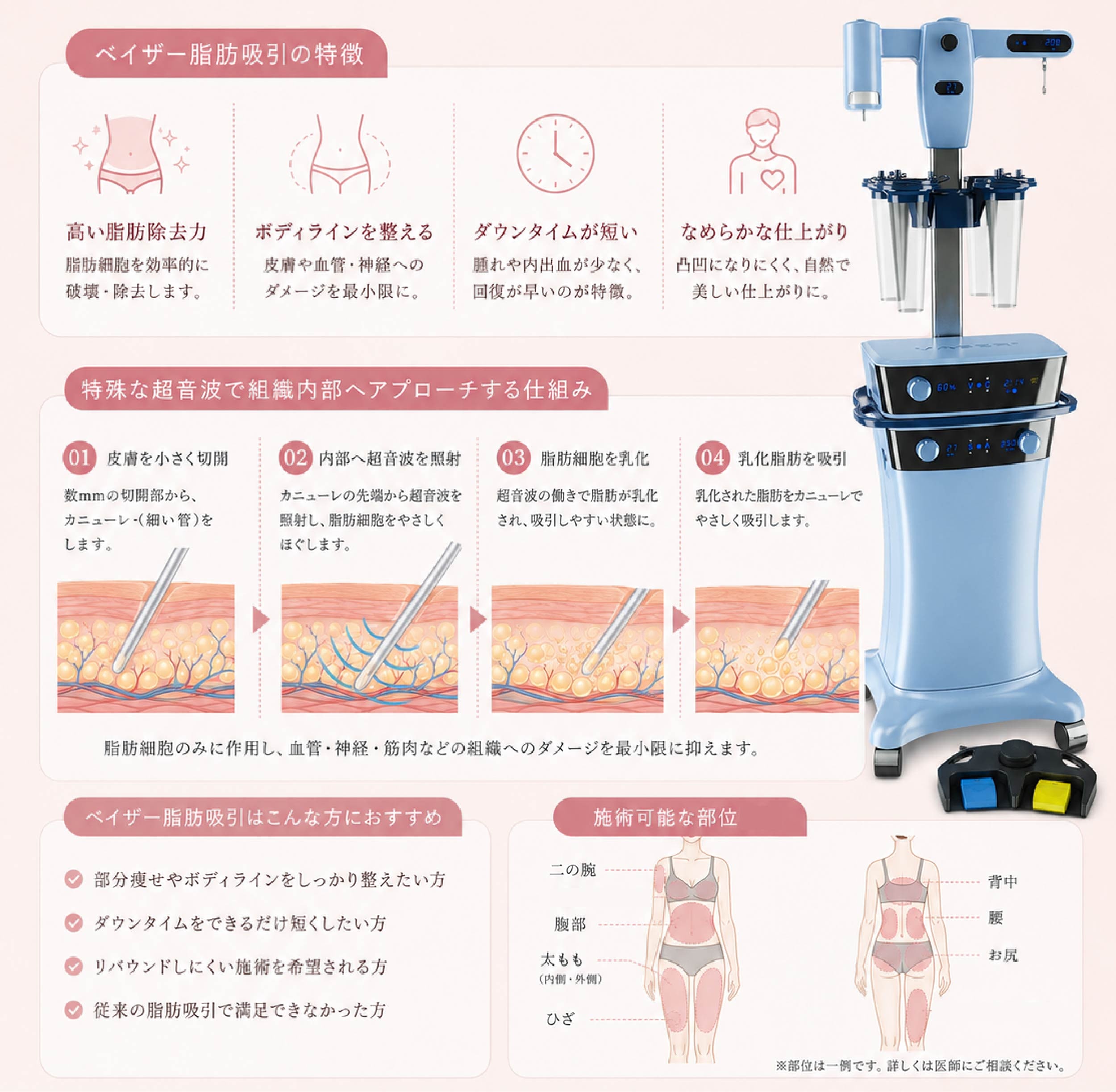 ベイザー脂肪吸引