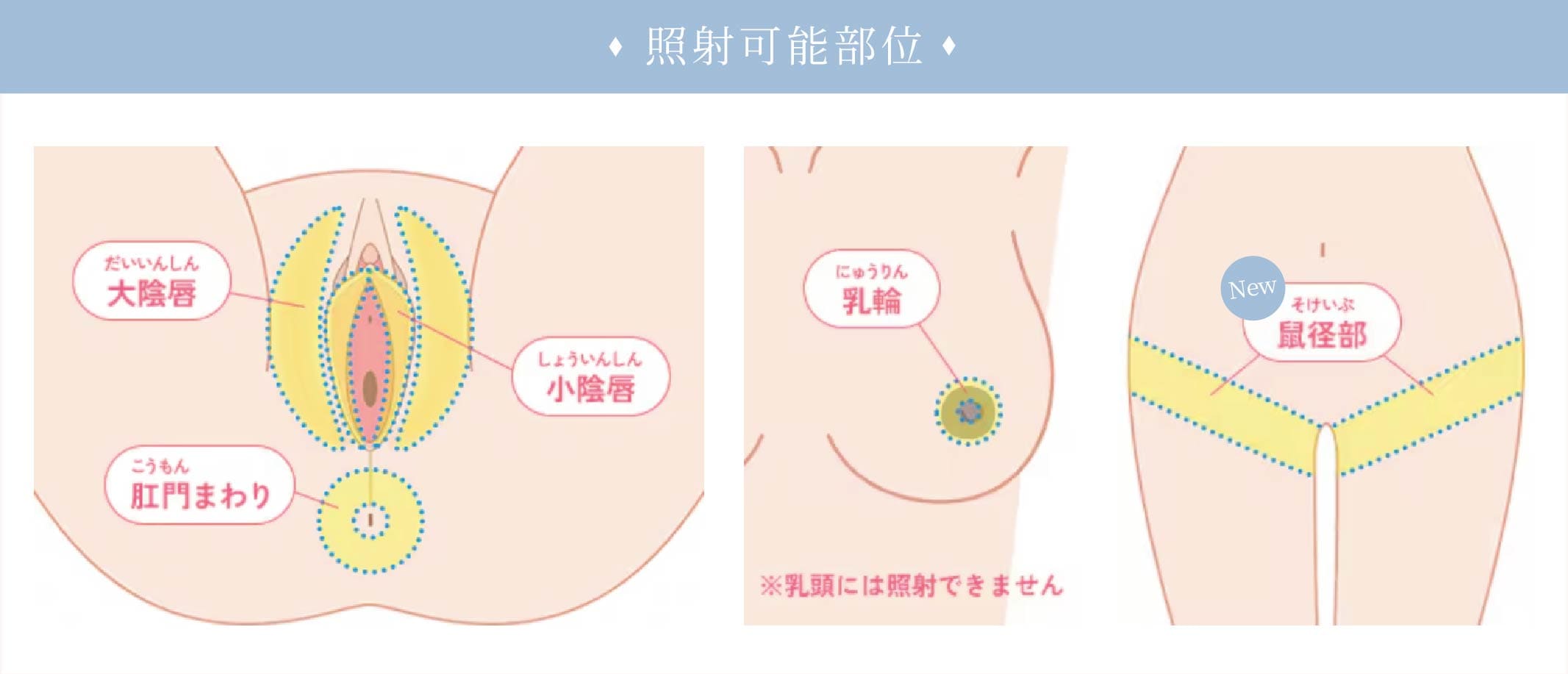 照射部位イメージ