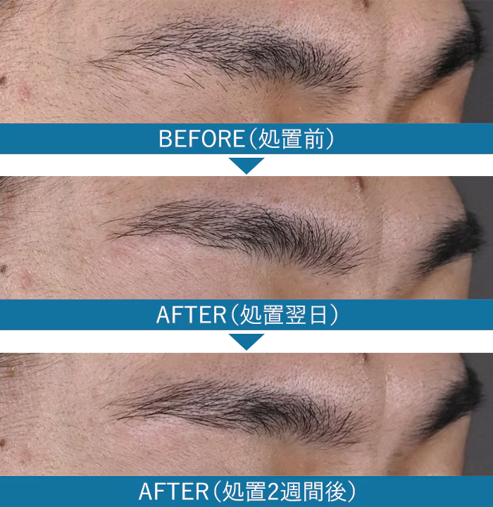 ニードル脱毛 症例写真2