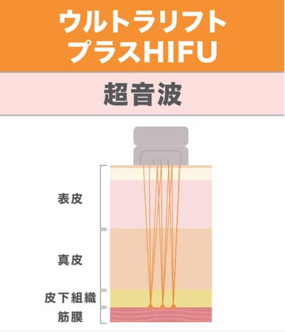 ウルトラリフトプラスHIFU 超音波 アプローチ図