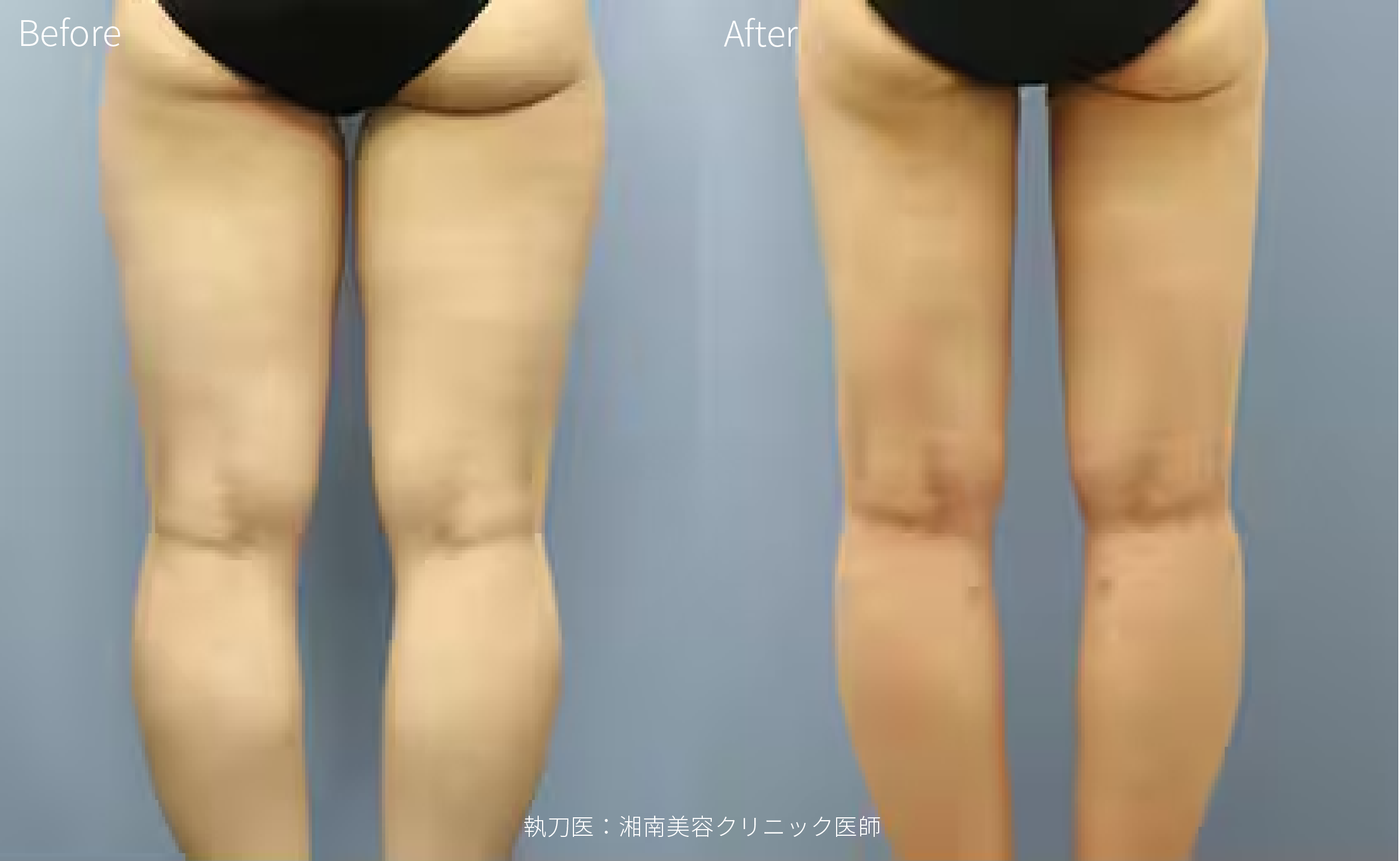 症例写真 太もも