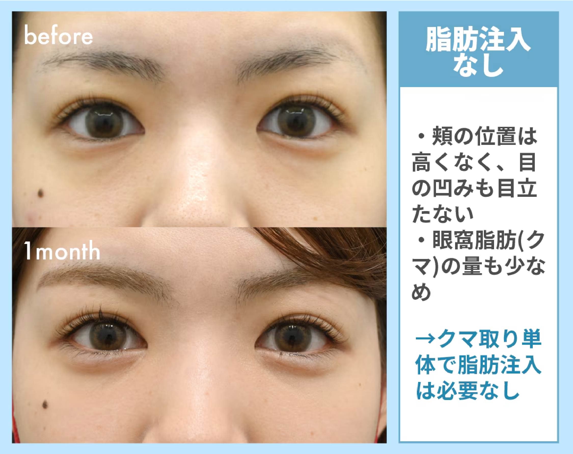 脂肪注入が不要なタイプ