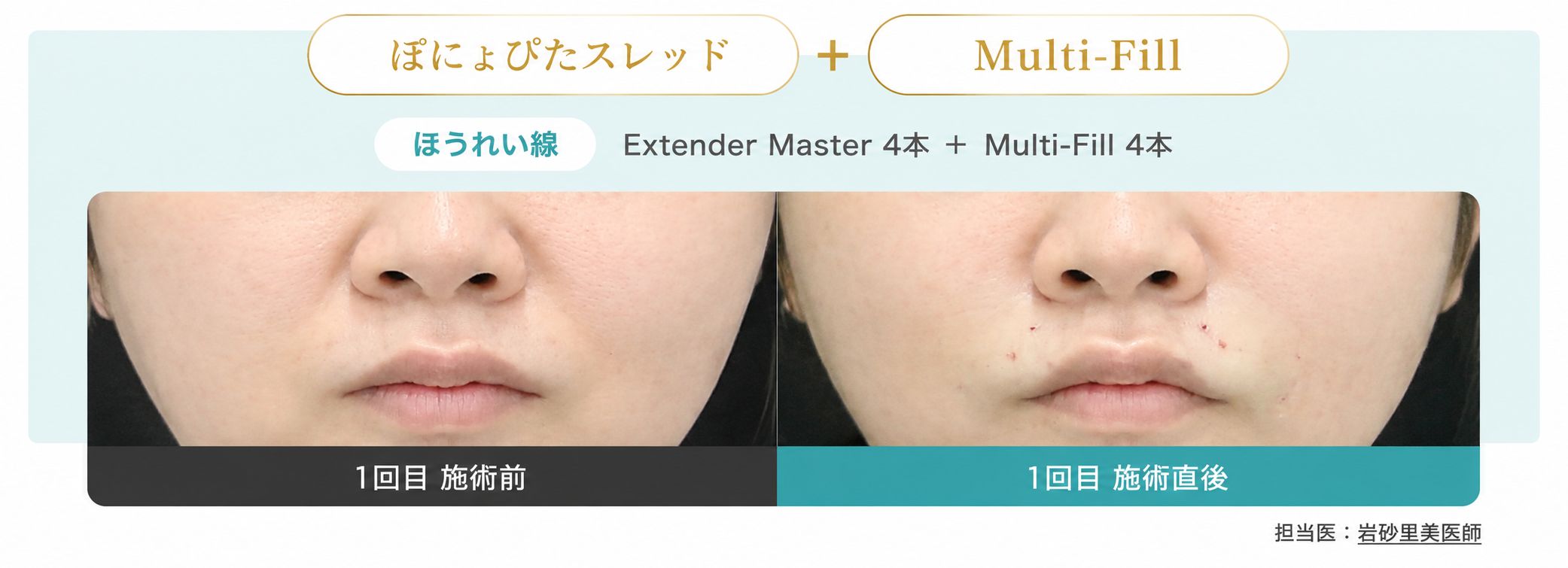 ぽにょぴたスレッド 症例① 術前・術直後