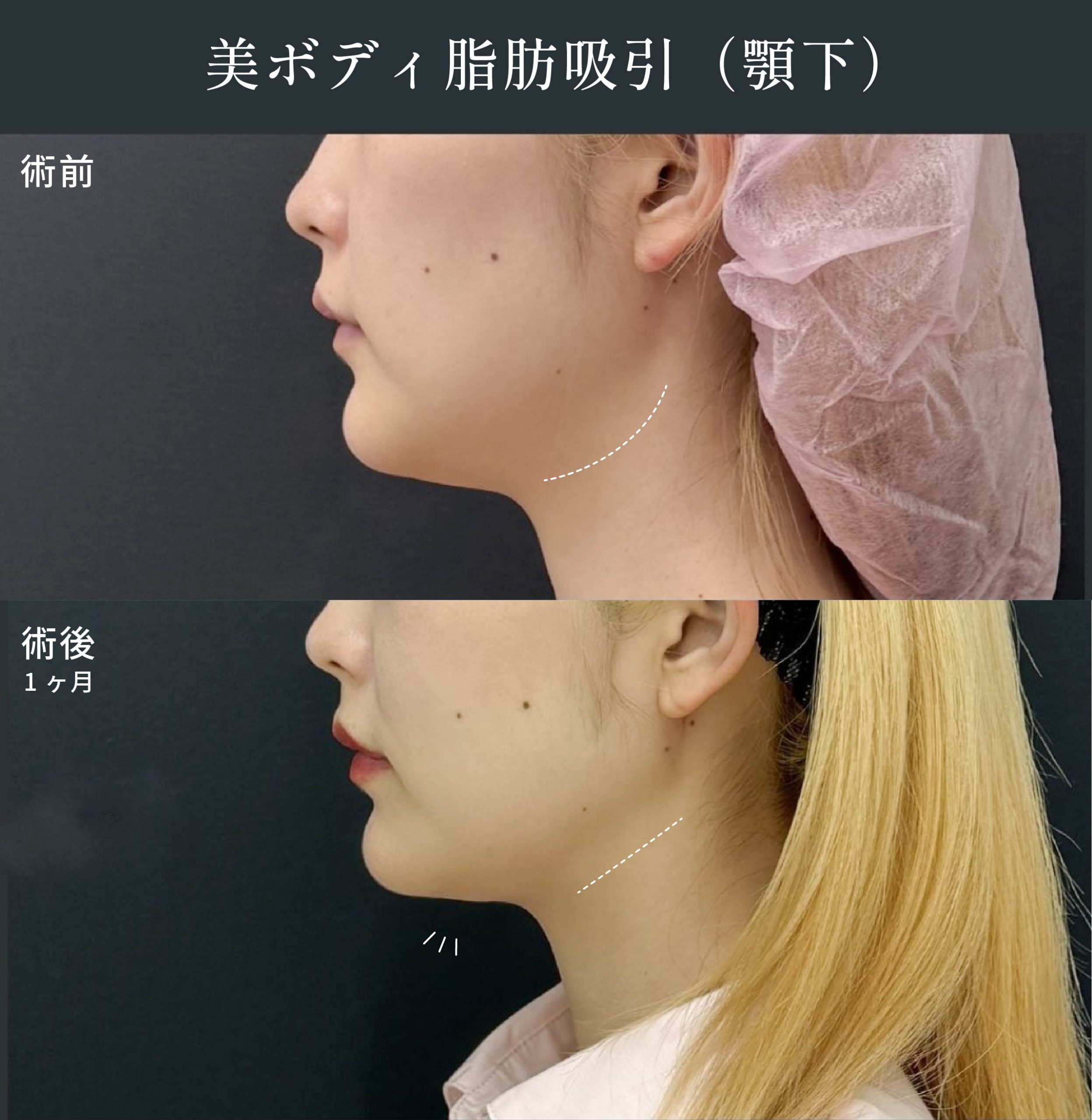 中井理絵医師の脂肪吸引症例1