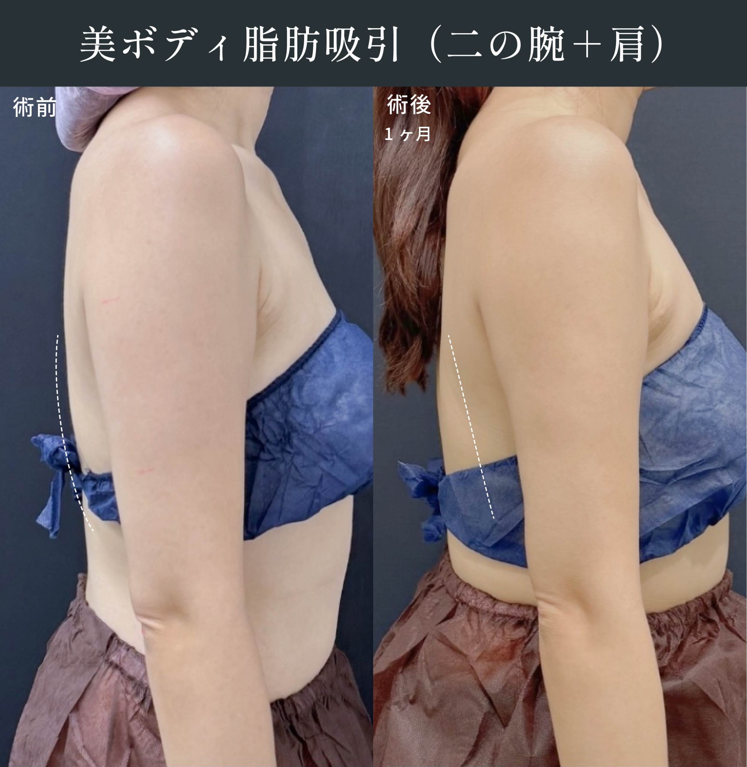 中井理絵医師の脂肪吸引症例2