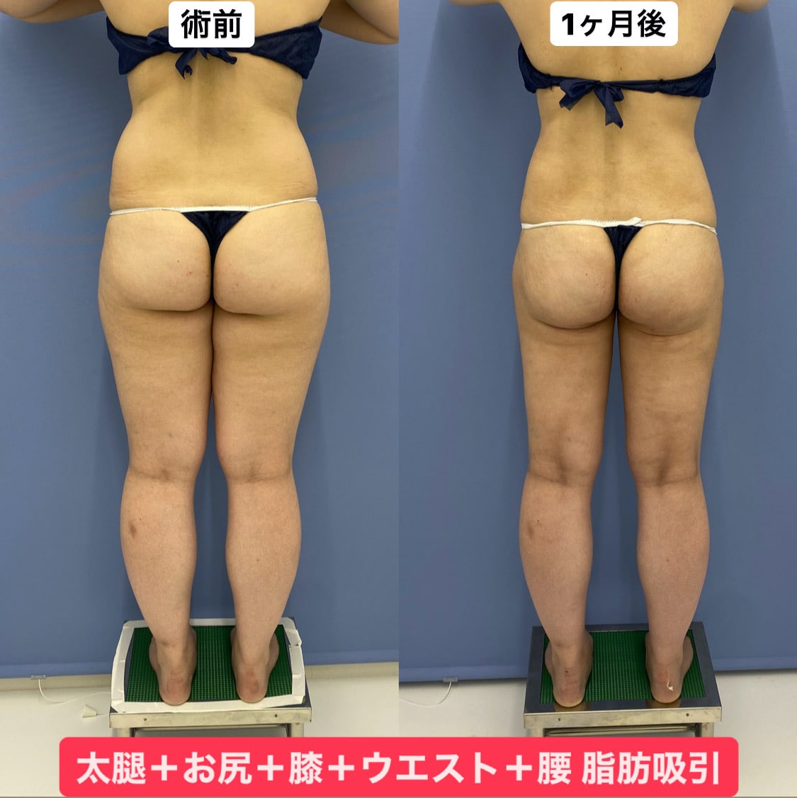 2017顔出しシミ付きパンツ 銀座院】太もも脂肪吸引で絶対美脚を作る - 銀座院