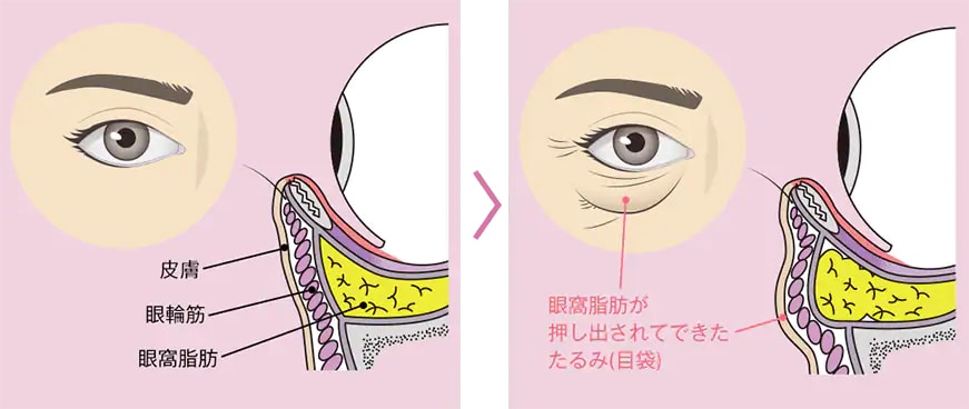 そもそもなぜ目の下がふくらむの？