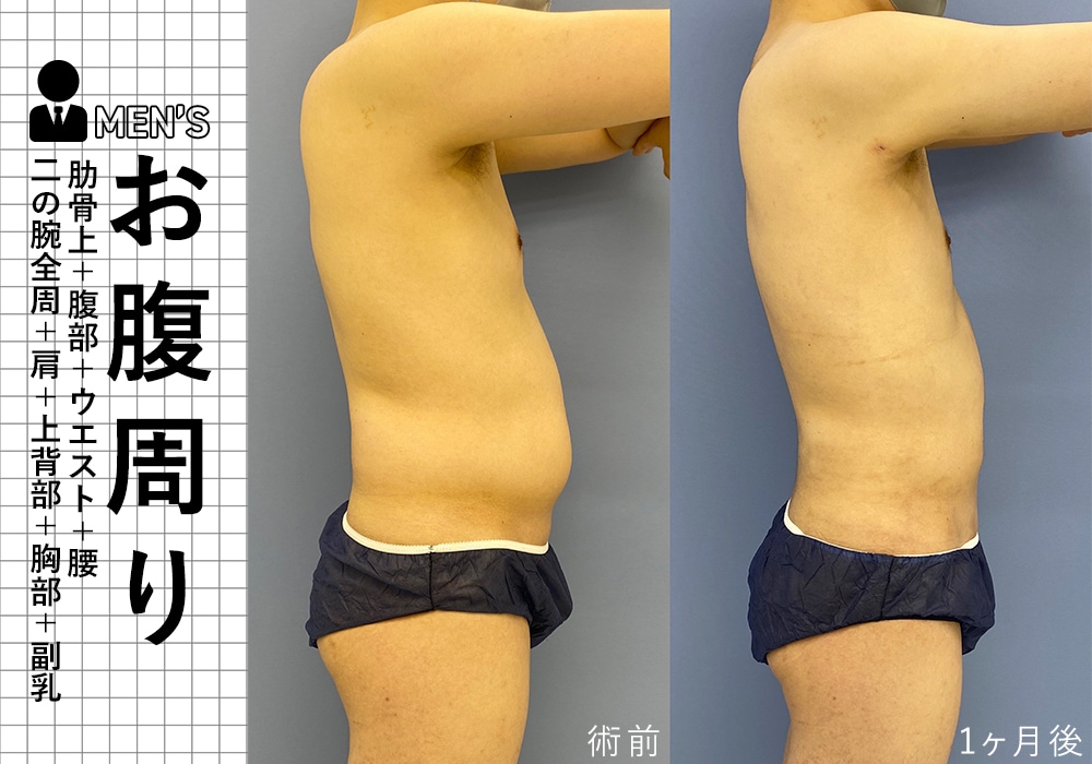 顔染みパンティ 男の脂肪吸引！顔やお腹、胸まで！症例多数の湘南美容クリニック銀座院で気になる部位を部分痩せ♪ - 銀座院