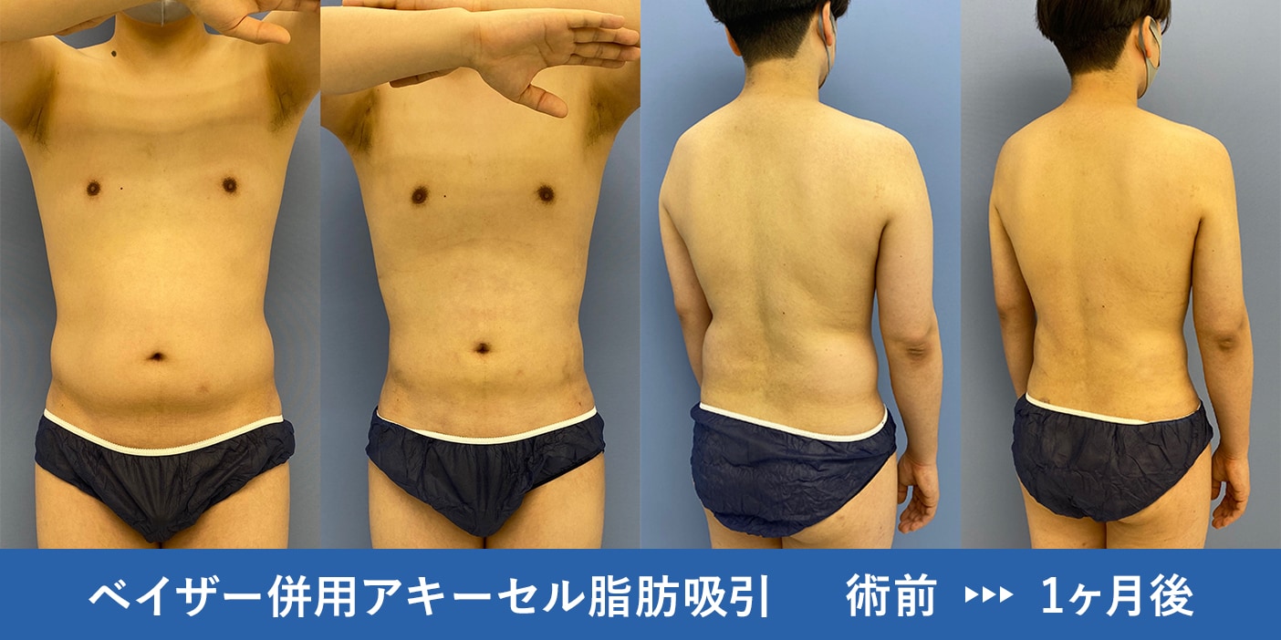2017顔出しシミ付きパンツ 男の脂肪吸引！顔やお腹、胸まで！症例多数の湘南美容クリニック銀座院で気になる部位を部分痩せ♪ - 銀座院