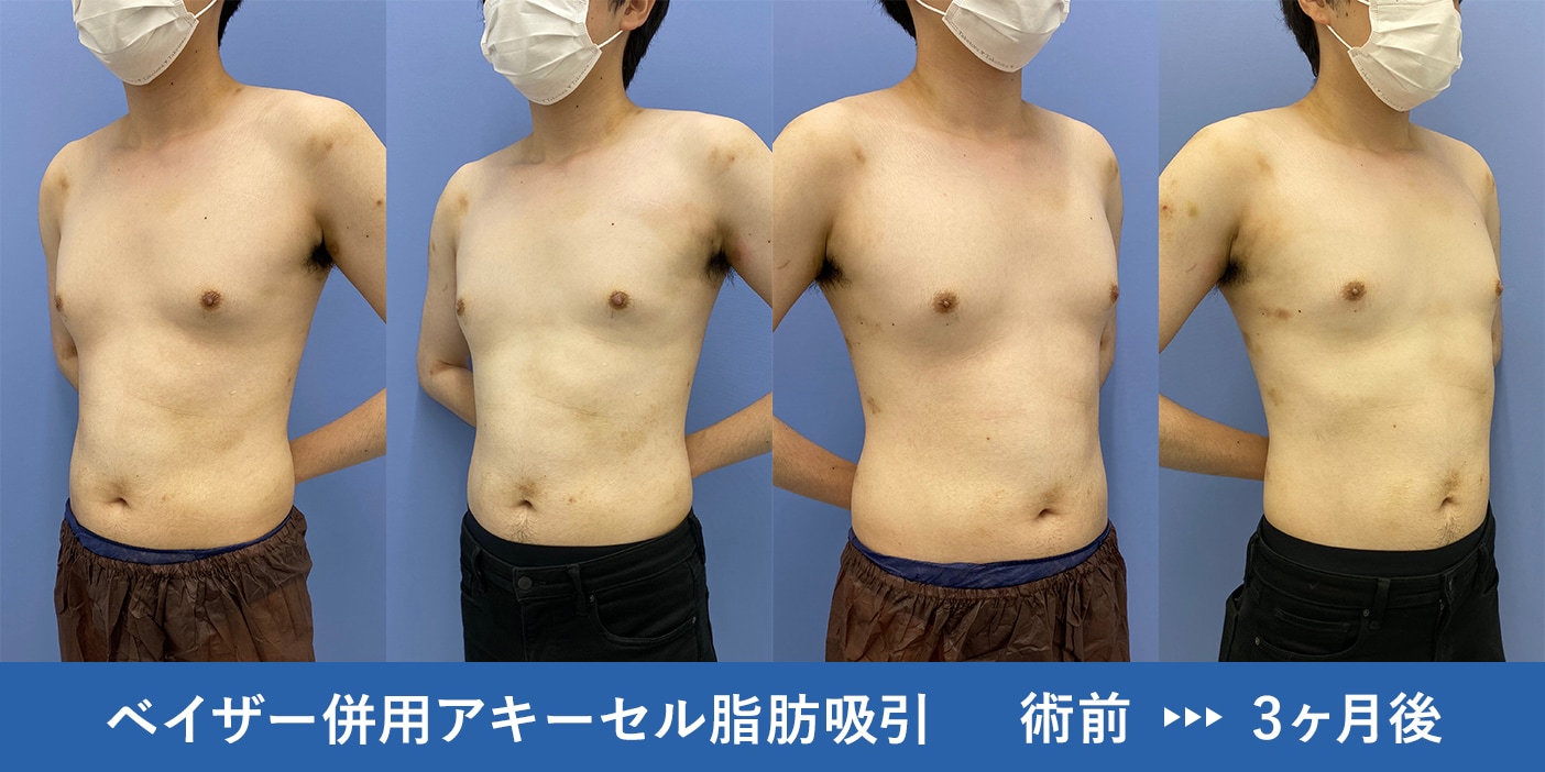 JSのふくらみかけのおっぱい3 男の脂肪吸引!顔やお腹、胸まで!症例多数の湘南美容クリニック銀座院で気になる部位を部分痩せ♪ - 銀座院
