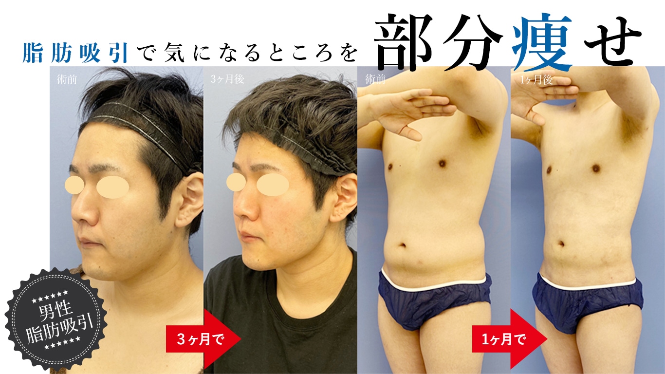 脂肪吸引＋30代・40代＋男性＋症例写真