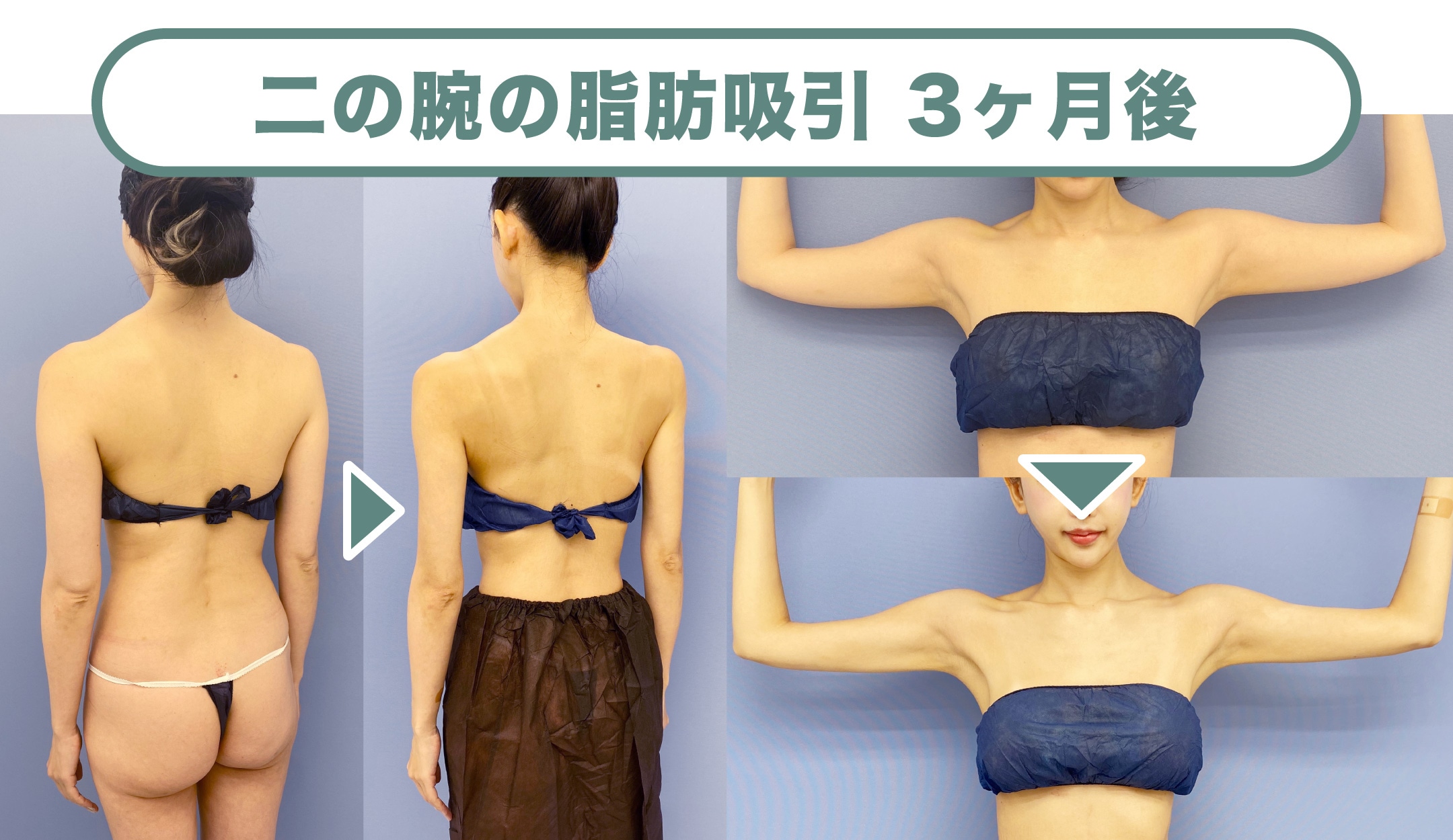2017顔出しシミ付きパンツ 脂肪吸引注射と脂肪吸引の違いとは？SBC銀座院・脂肪吸引の名医が解説します！ - 銀座院