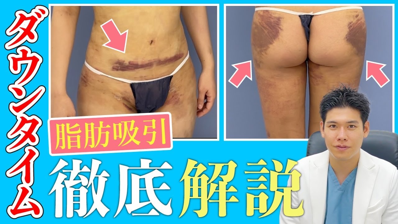 脂肪吸引後のむくみや腫れのピークは？いつまで続くのかダウンタイムを解説！