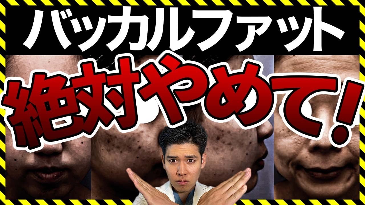 バッカルファット除去はこけるからおすすめしない？失敗が怖い人必見！