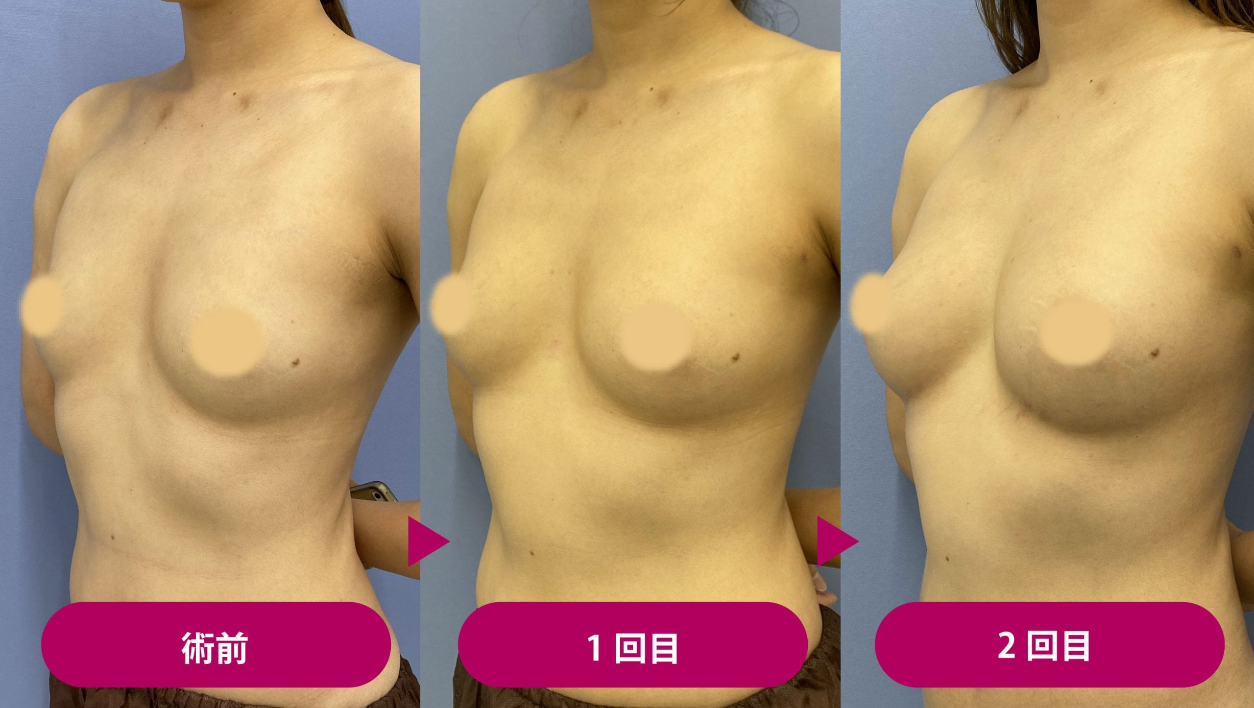 豊胸　巨乳 