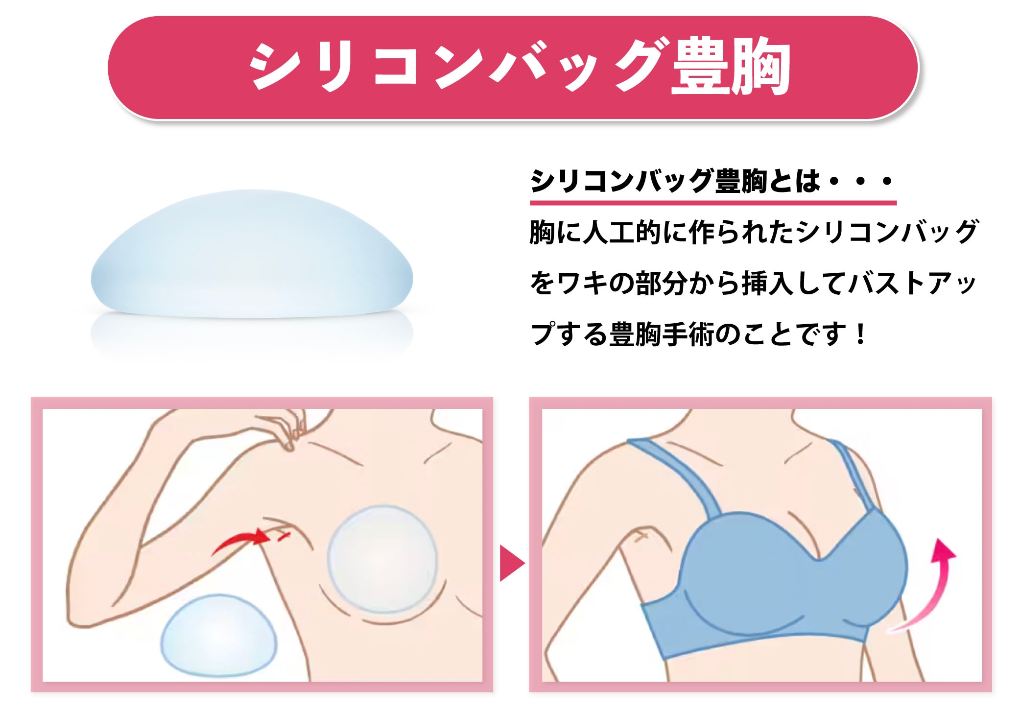シリコンバック豊胸のデメリット5選！触り心地の不自然さについて 