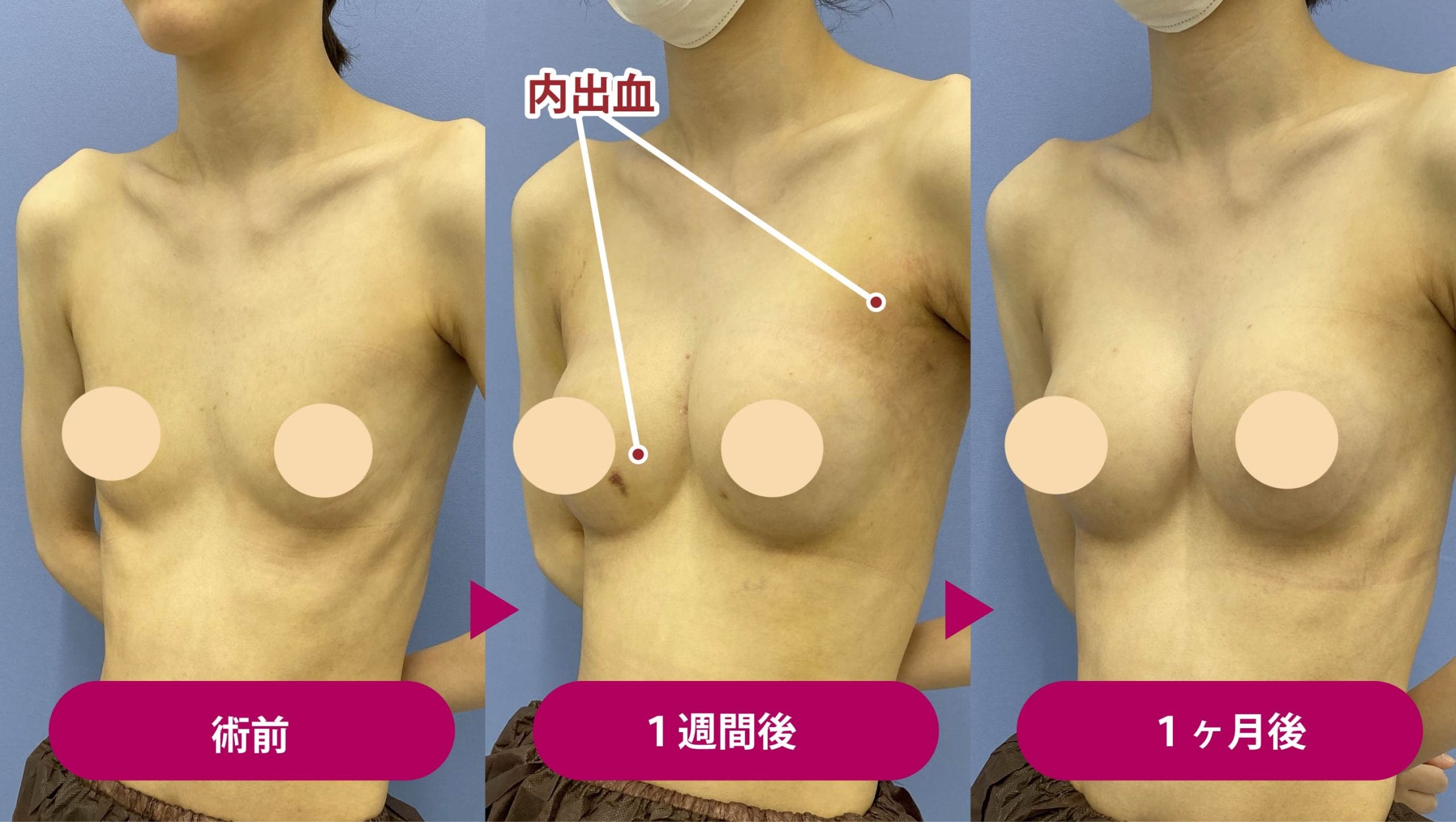 豊 胸 手術