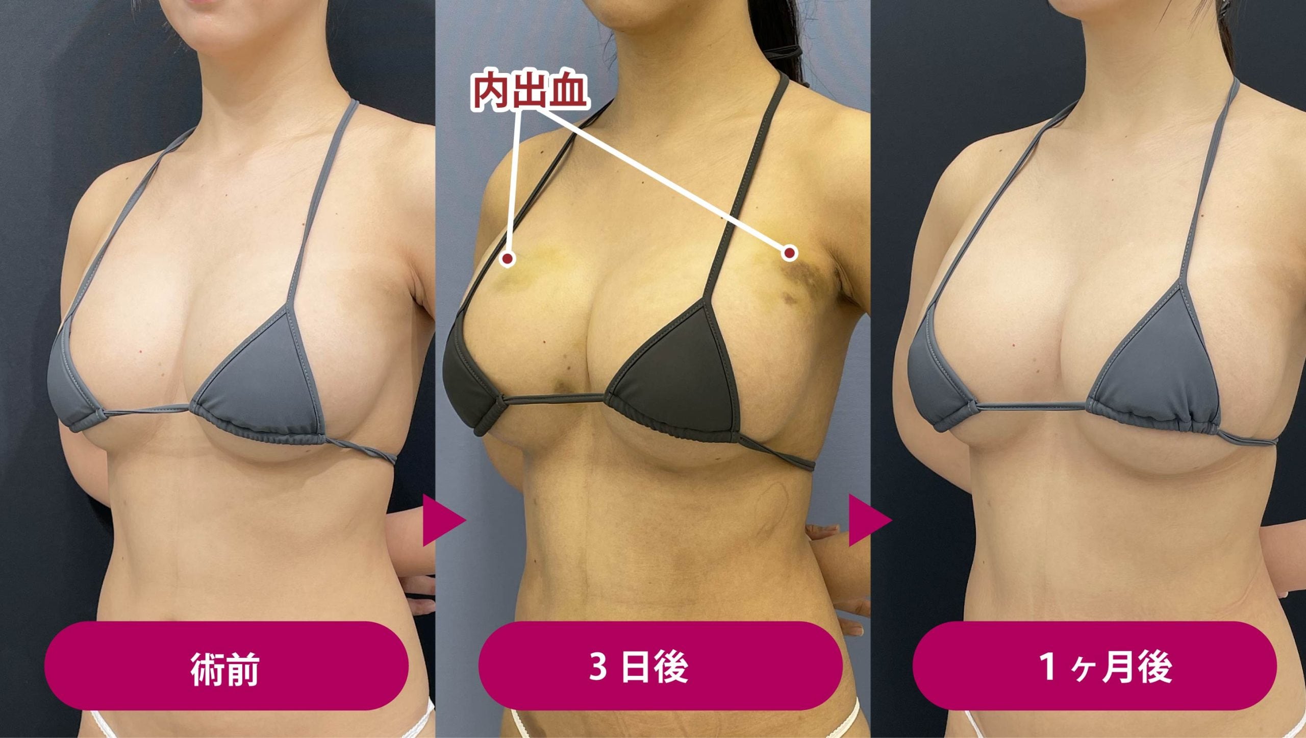 豊胸　術前 
