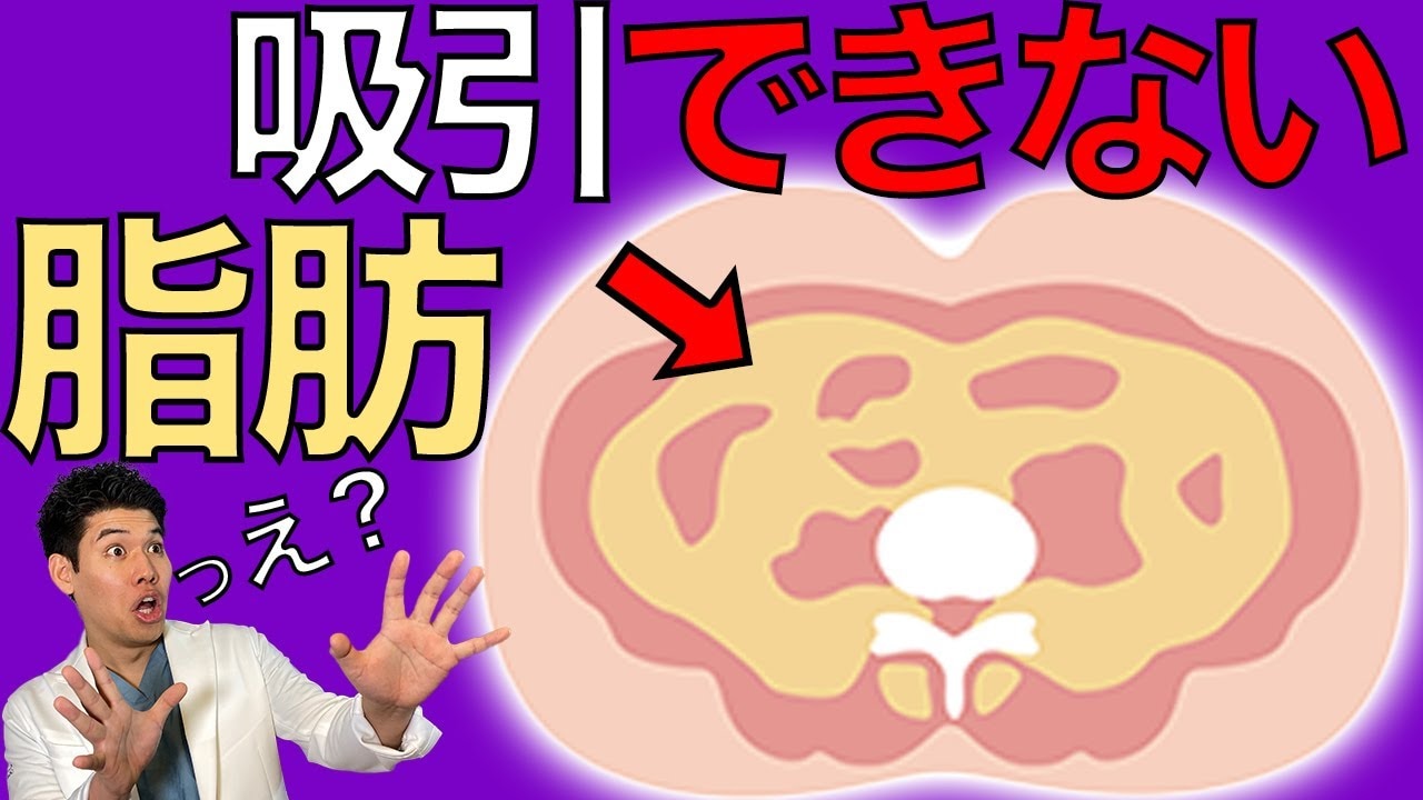 皮下脂肪と内臓脂肪の見分け方や違いは？女性で脂肪吸引を検討している方は必見！