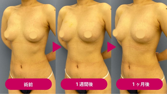 シリコンバッグ豊胸手術のデメリット④脂肪注入豊胸に比べると見た目や触り心地が劣る