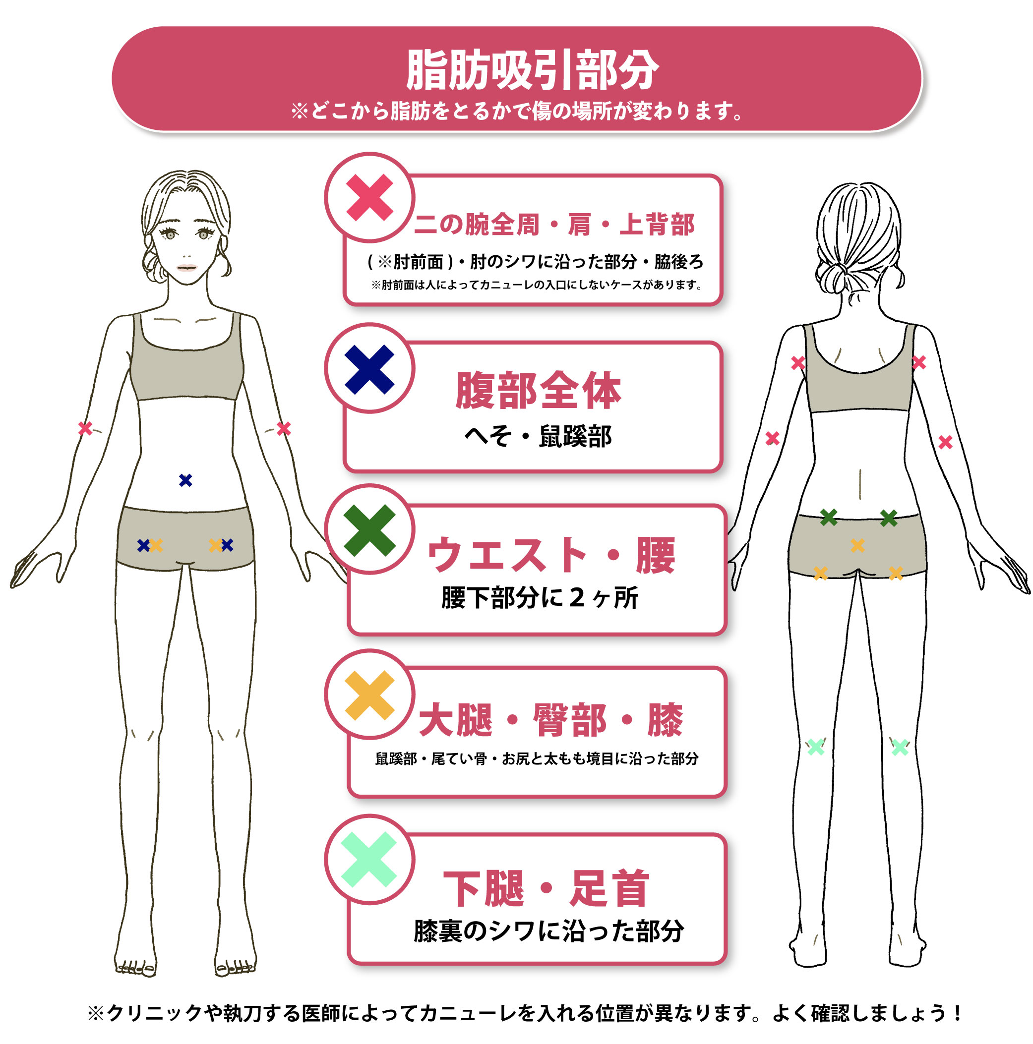 豊胸手術の傷はどこにできる？豊胸手術の傷・傷跡を症例写真と共にご 